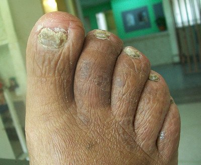 Toenail Fungus picture