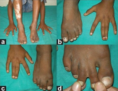 Syndactyly in Waardenburg syndrome type 3 image