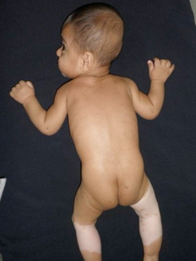 congenital leucoderma in Waardenburg syndrome photo