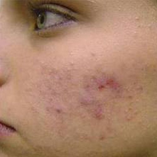 A woman with a moderate pimple marks on the face.image
