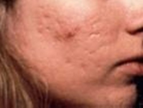 A woman with a severe acne marks.picture