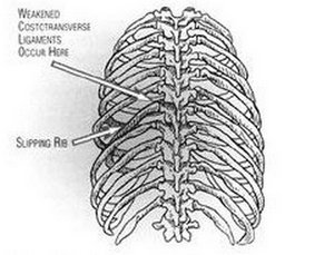 A clinical representation of slipping rib syndrome outlining the position of the slipped rib and the weakened ligaments in the rib area.picture