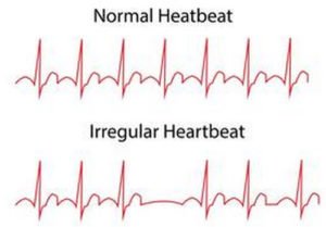 erratic heartbeat health anxiety