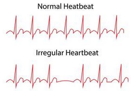 An ECG report comparison of a normal heartbeat and irregular heartbeat.image