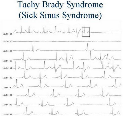 An electrocardiogram result of a patient with tachy brady syndrome.picture