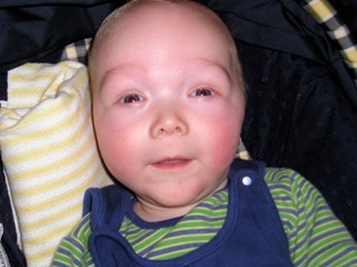 An infant with sotos syndrome characterized by pointed chin, big head, wide forehead, and pinkish cheeks.picture
