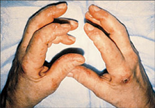 An image of patients with mechanics hands, which is one of the clinical manifestations of antisynthetase syndrome.photo