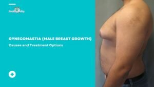 Gynecomastia (Male Breast Growth)- Causes and Treatment Options