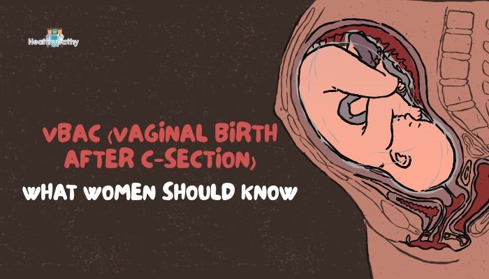 VBAC (Vaginal Birth After C-Section)- What Women Should Know
