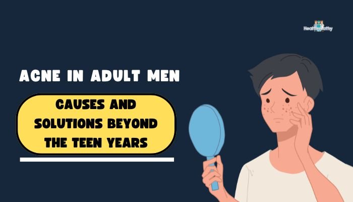 Acne in Adult Men: Causes and Solutions Beyond the Teen Years